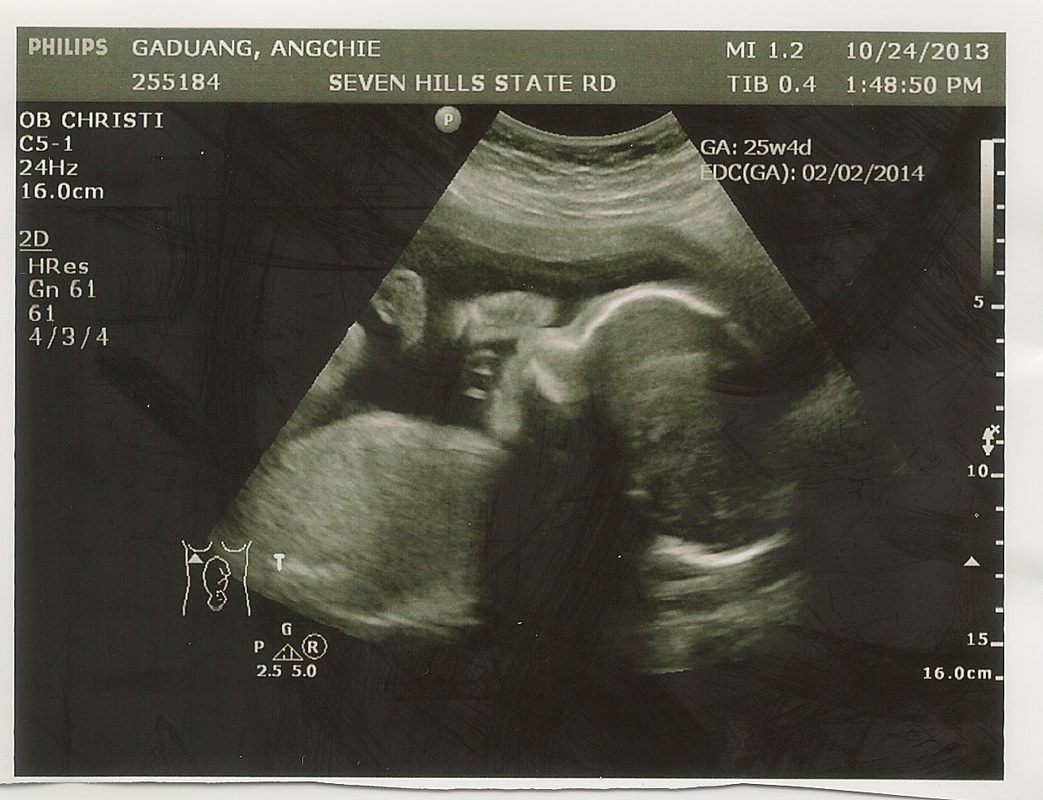 early sonogram picture